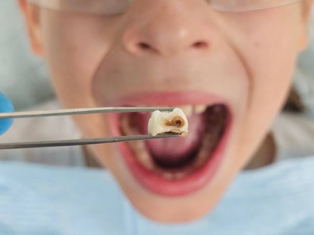 Best Root Canal Emergency Dentist  in Maynardville, TN